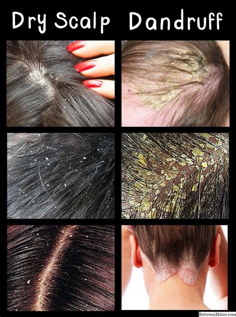 Dandruff Vs Dry Scalp Causes Treatment And Differences Hairstory | Porn Sex Picture