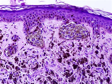 Congenital Melanocytic Nevus Histology