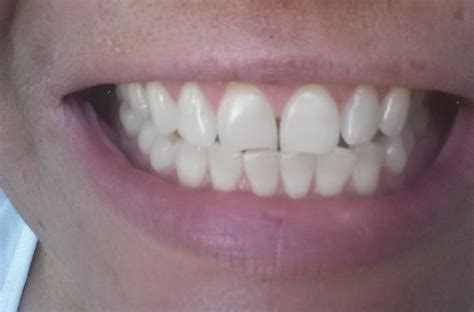 Frugal Shopping and More: Smile Brilliant Teeth Whitening #Review and # ...