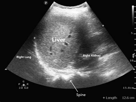 Liver Ultrasound Anatomy