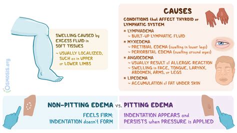 Non-pitting Edema: What Is It, Causes, Diagnosis, Treatment and More | Osmosis