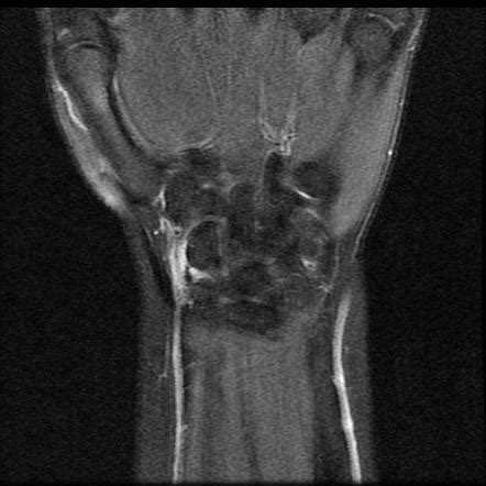 Ulnar Collateral Ligament Wrist Mri