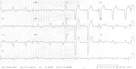 Left Bundle Branch Block (LBBB) • LITFL • ECG Library Diagnosis