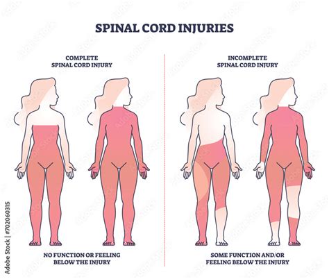 Spinal cord injuries with complete or incomplete trauma outline diagram. Labeled educational ...