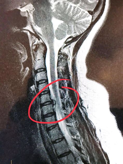 I was told I had Cervical Spinal Stenosis, but it looks more like a Herniated disk? : MRI