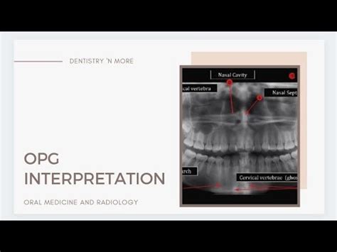 OPG INTERPRETATION - CLINICAL CASES - YouTube