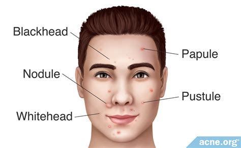 What Is an Acne Papule? - Acne.org