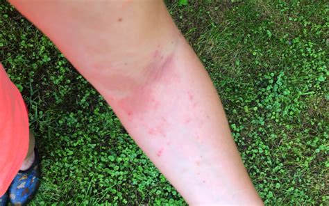 5 Natural Remedies for Poison Ivy Rashes - Allegheny Kiski Health ...