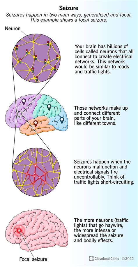 Epilepsy Brain Diagram