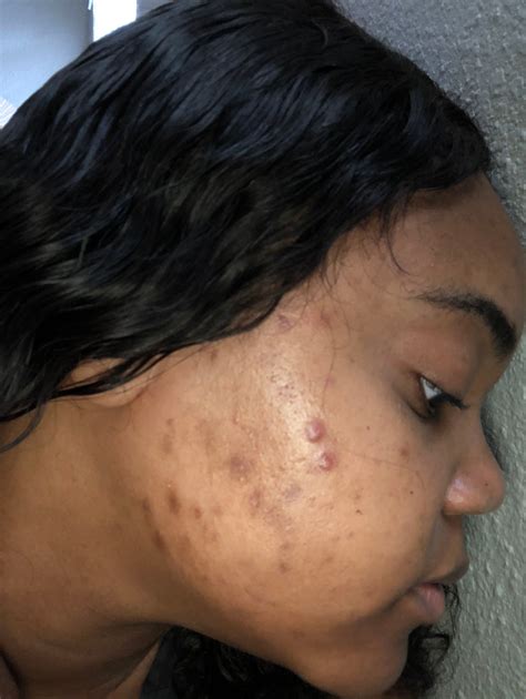 Hyperpigmentation/Acne scars - Beauty Insider Community