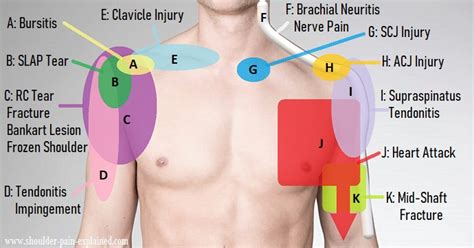 Shoulder Pain Diagram: Diagnosis Chart - Shoulder Pain Exp