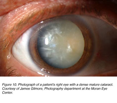 Crystalline Lens and Cataract by Joah F. Aliancy and Nick Mamalis – Webvision