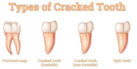 Cracked tooth? Your Fort Lauderdale Cosmetic Dentist has treatment options for your cracked ...