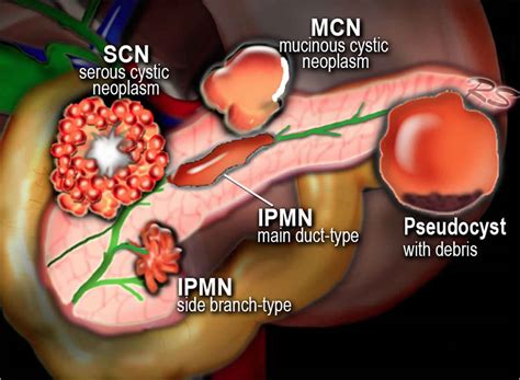 Mucinous cystic neoplasm pancreas causes, symptoms, diagnosis, treatment & prognosis