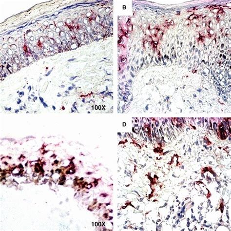 CD1 expression in leprosy skin lesions. A, a few positive cells in... | Download Scientific Diagram