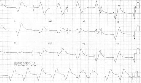 Hyperkalemia Ekg