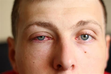 Pink Eye - Symptoms, Causes And Associated Complications