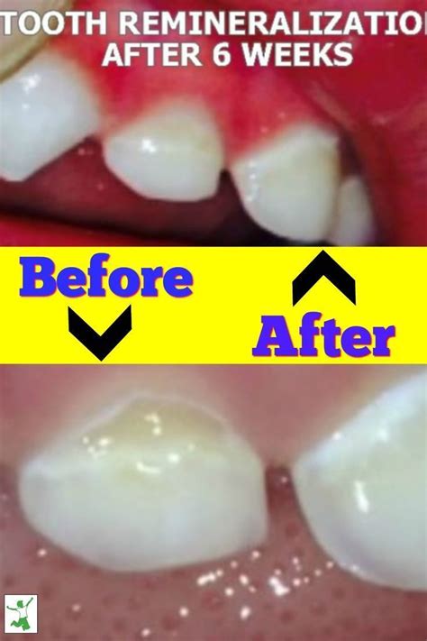 Photographic Proof of Remineralized Cavities - Healthy Home Economist | Heal cavities, Cavities ...