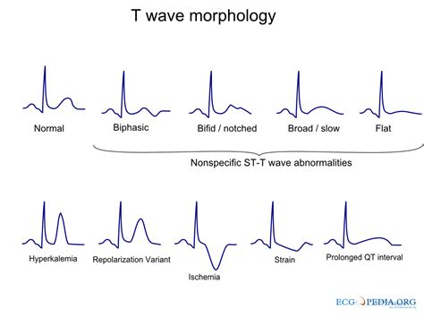 File:T wave morphology.png - ECGpedia