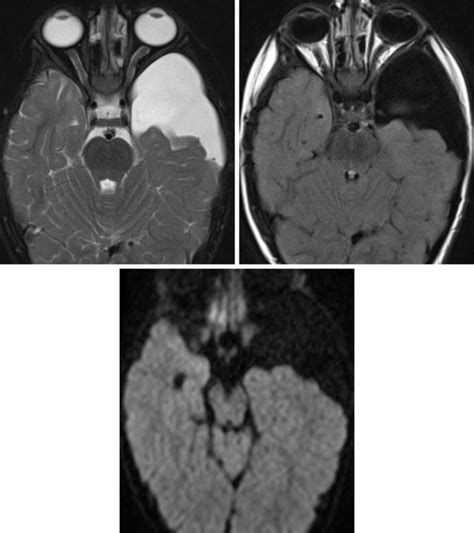 Arachnoid Cyst (AC) | The Neurosurgical Atlas, by Aaron Cohen-Gadol, M.D.