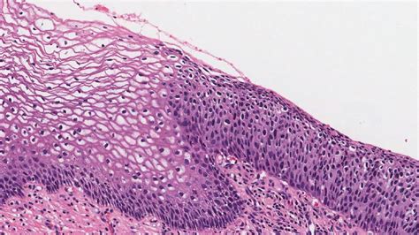 Cervical intraepithelial neoplasia (CIN) | MyPathologyReport.ca