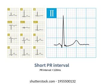 Pr Interval Ecg Shortened There History Stock Illustration 1955500132 | Shutterstock