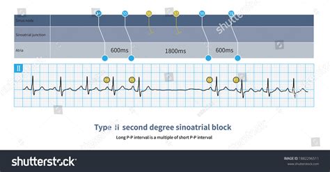 Type Second Degree Sinoatrial Block Long Stock Illustration 1882296511 ...