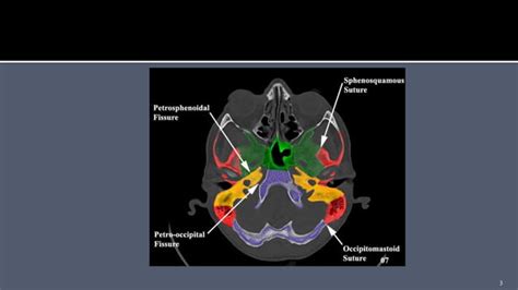 Petroclival Meningioma