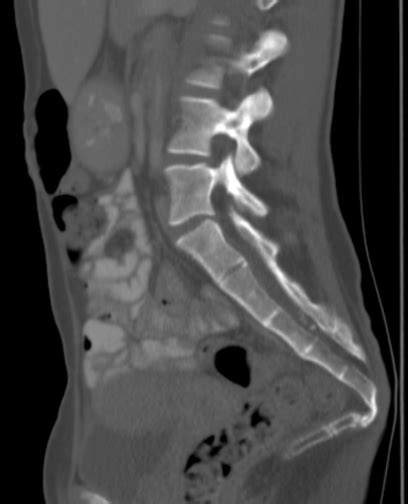 Coccydynia - Causes, Symptoms and Treatment | Bone and Spine