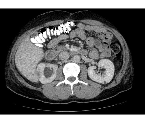 Pyelonephritis CT scan - wikidoc