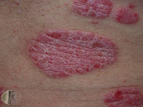 Common skin rashes and what to do about them