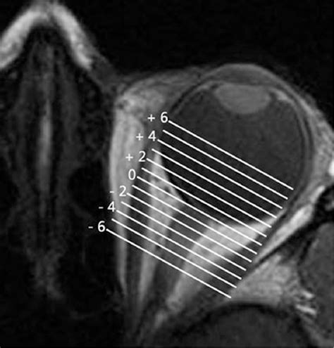 Figure 1 from Heavy eye syndrome versus sagging eye syndrome in high myopia. | Semantic Scholar