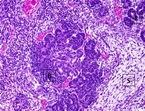 Histology of Wilms tumor Example of a triphasic Wilms tumor with... | Download Scientific Diagram