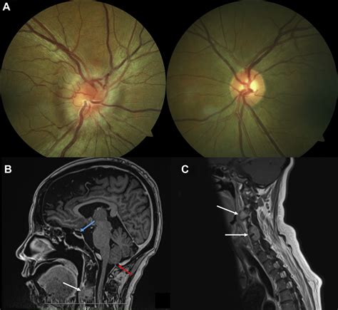 Unilateral Papilledema as the Presenting Sign of Spinal Metastases ...