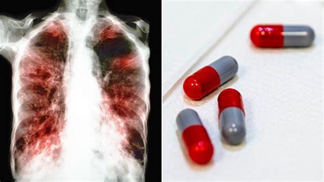 Treatment for Tuberculosis: Antibiotic Medications