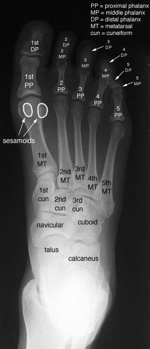 Radiographic Anatomy of the Skeleton: Foot -- Anteroposterior (AP) View ...