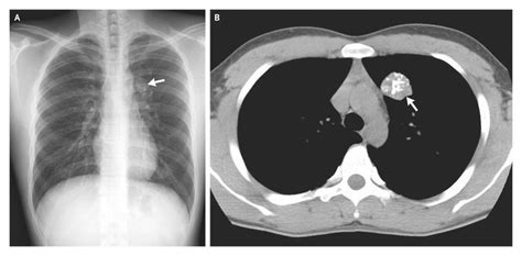 “Popcorn” Calcifications in a Pulmonary Chondroid Hamartoma | NEJM | Radiology, Pulmonary ...