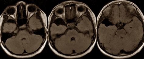 Arachnoid Cyst - Pictures, Symptoms, Causes, Treatment - (2018 - Updated)