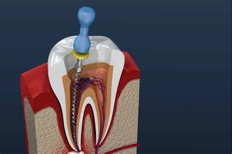 What Should I Do If I Have Pain After Root Canal Treatment?