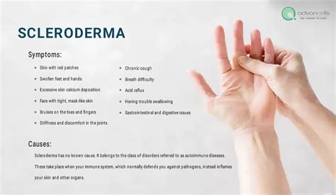 Scleroderma Symptoms, Causes, Types, Diagnosis & Treatment