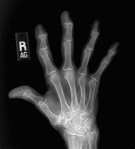 Hand Bones Xray