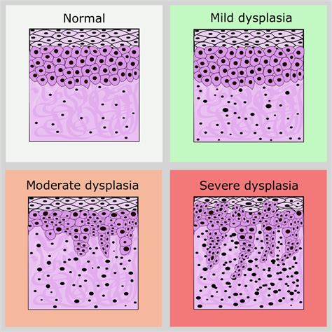 Metaplasia Dysplasia Neoplasia