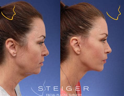 Facelift Before and After Photos | Deep Plane Facelift