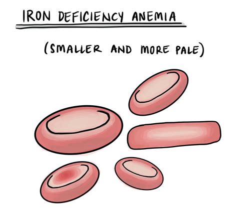 Iron deficiency anemia - MyPathologyReport.ca