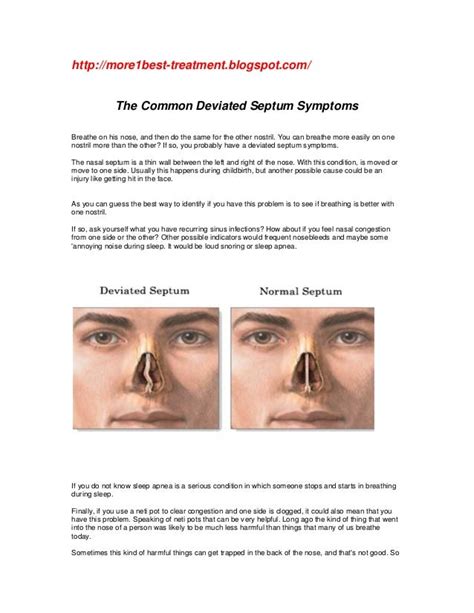 The common deviated septum symptoms