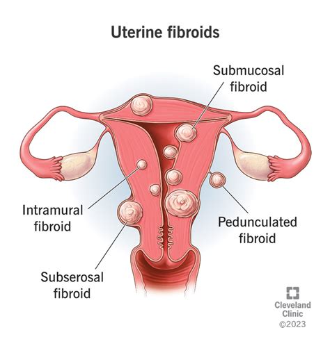 Understanding Fibroids: Causes, Symptoms, And Treatments - Ask The ...