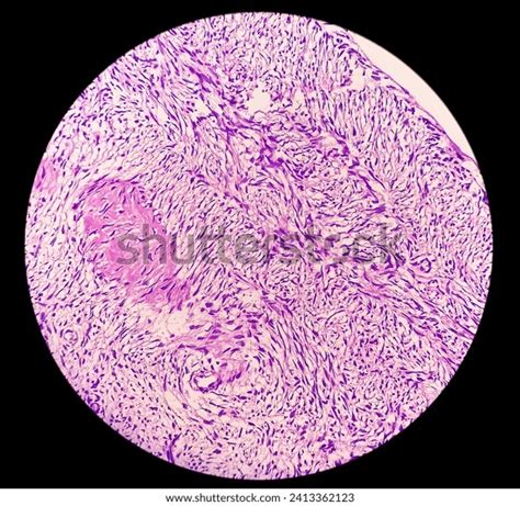 Histology Peritoneal Inclusion Cyst Paraovarian Cysts Stock Photo 2413362123 | Shutterstock