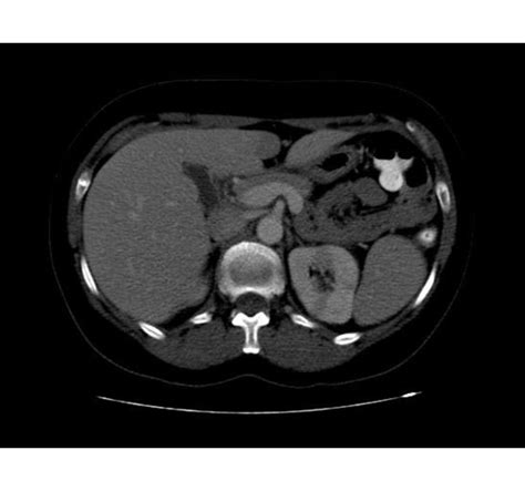 Pyelonephritis CT scan - wikidoc