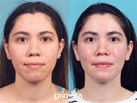 Buccal Fat Removal for Orlando & Winter Park, FL | Primera Plastic Surgery