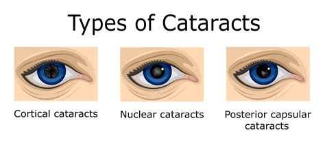 Cataract - how it affects vision | Medical Tourism Italy